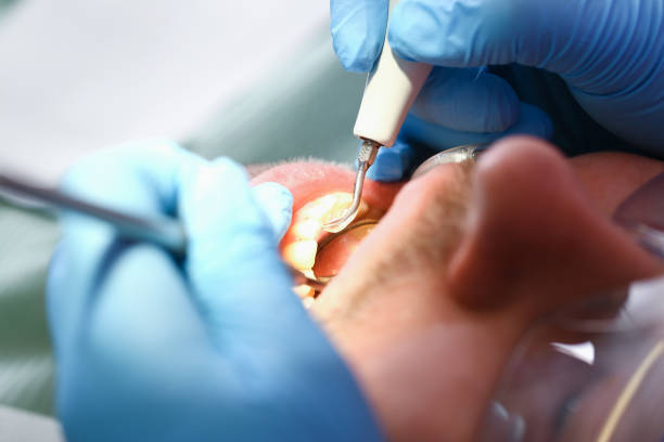Best Emergency Dental Care for Broken or Chipped Teeth in Woodmere, NY